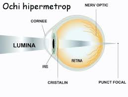 miopia apare atunci când exerciții terapeutice pentru ochi hipermetropi
